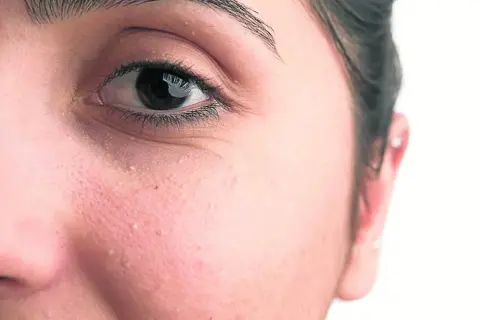 Primer plano del ojo y mejilla de una persona con pequeños quistes de milium blancos visibles en la piel.