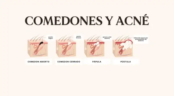 Ilustración explica porque salen puntos negros en la cara: comedón abierto, cerrado, pápula y pústula, mostrando la acumulación de grasa y piel muerta.