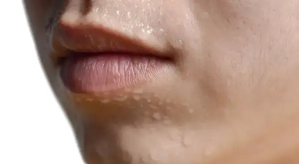 Primer plano de un rostro con gotas de sudor, evidencia de hiperhidrosis facial.