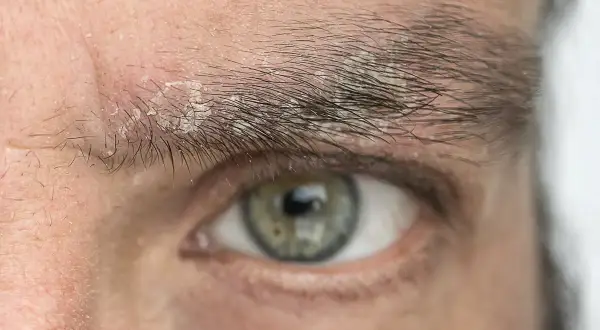 Primer plano de un ojo con caspa en las cejas, mostrando escamas blancas y piel irritada.