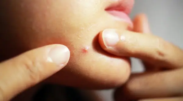 Dedos apuntan a un grano rojo en la barbilla. ¿Buscas como quitar un grano rápido?