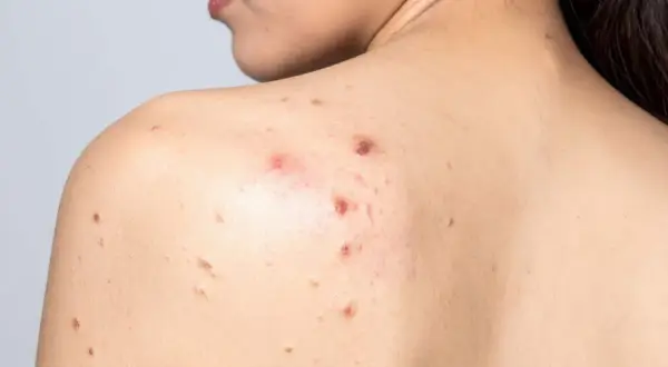 Espalda con acné, mostrando varios granos inflamados sin punta y marcas de curación.