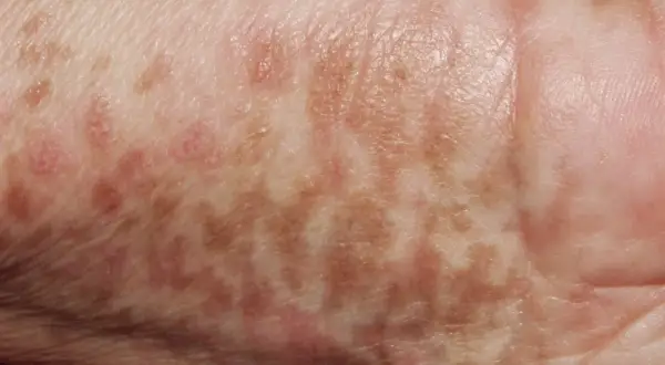 Piel con manchas marrones y rosadas, indicativas de hiperpigmentación postinflamatoria.