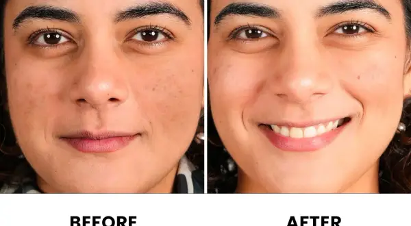 Comparación antes y después de una cara. La piel luce más uniforme y radiante tras el uso de vitaminas.