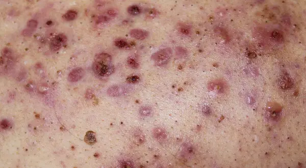 Piel con múltiples pápulas, pústulas y nódulos inflamados, característicos del acne conglobata.