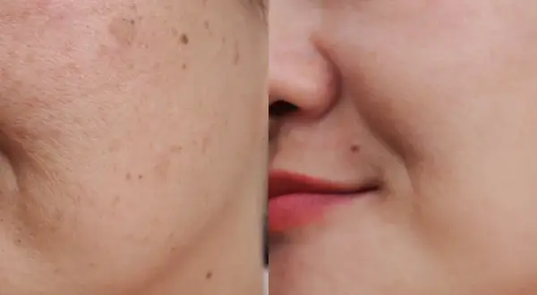 Comparación antes y después de un tratamiento para eliminar manchas de la cara. La piel luce más uniforme y radiante.