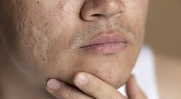 Primer plano de un rostro con marcas de acné. Se muestra la mejilla, la nariz y la boca, con una mano tocando la barbilla. Una guía sobre como quitar marcas de acne.