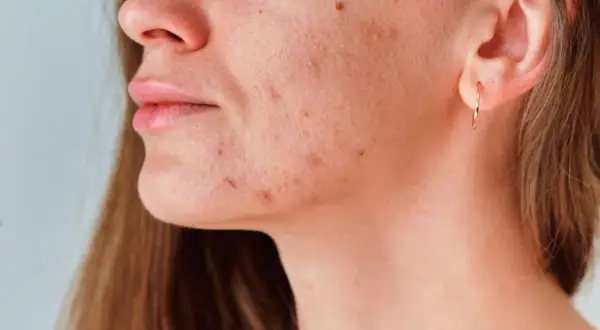 Primer plano de una mujer con granos en el cuello y la mandíbula, mostrando la textura de su piel.