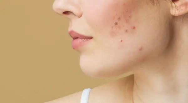 Primer plano de una mejilla con acné. Busca productos no comedogénicos para una piel más sana.