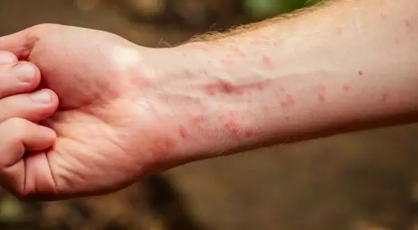 Brazo con erupción roja, posiblemente tiña en la piel, con pequeñas protuberancias y enrojecimiento.