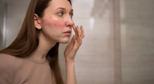 Mujer con sarpullido en la cara, aplicándose crema.