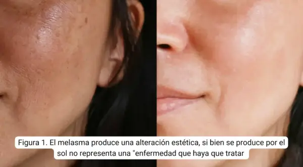 Comparación de piel con melasma y piel tratada. El ácido tranexámico puede ayudar a mejorar la apariencia de las manchas.