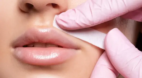 Manos enguantadas retiran banda de cera del labio superior, tratando el melasma bigote.