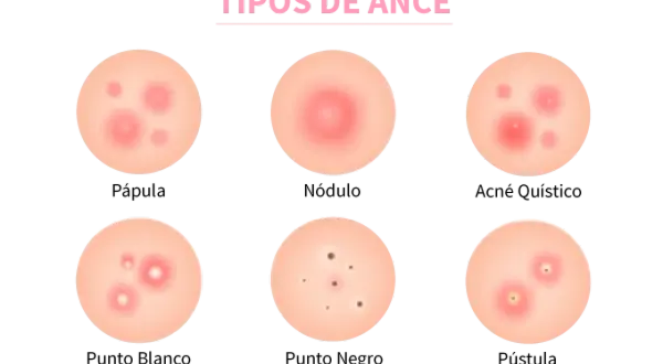 Ilustración de varios tipos de acné: pápula, nódulo, acné quístico, punto blanco, punto negro y pústula.