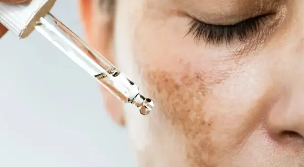 Gotas de suero para tratar el melasma que es, manchas oscuras en la piel.