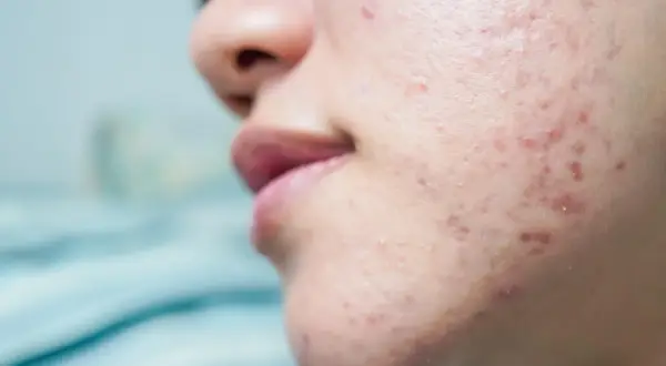 Primer plano de la mejilla de una persona mostrando marcas de acné por estrés, con granos rojos e inflamados.