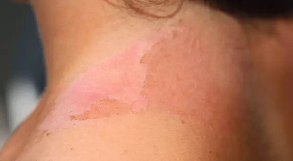 Piel enrojecida y descamada en el cuello, indicativo de un eritema solar severo tras una exposición prolongada al sol.