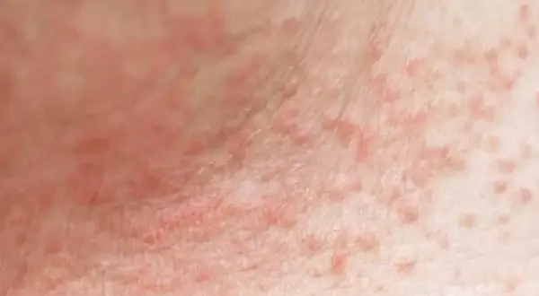 Piel con erupción de pequeños granos rojos, posiblemente por sudor.