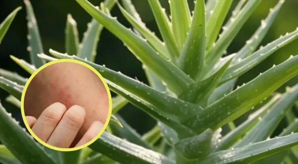 Primer plano de una planta de aloe vera con un círculo que muestra una piel irritada y enrojecida, sugiriendo contraindicaciones del aloe vera en la piel.