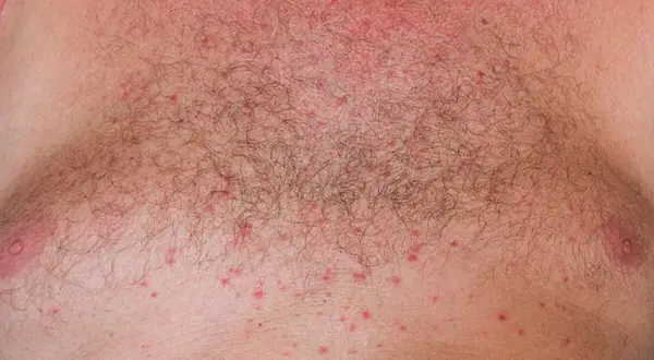 Pequeños bultos rojos cubren el pecho de un hombre, indicando un sarpullido por calor.
