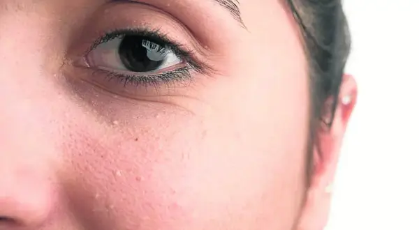 Primer plano del ojo y mejilla de una persona con pequeños quistes de milium blancos visibles en la piel.