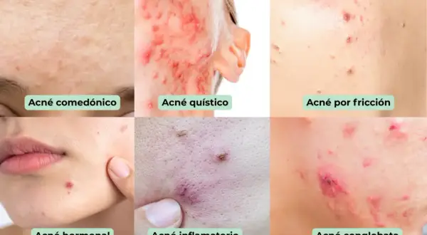Primer plano de diferentes tipos de acné, incluyendo acné en la frente, quístico, por fricción, hormonal, inflamatorio y   conglobata.