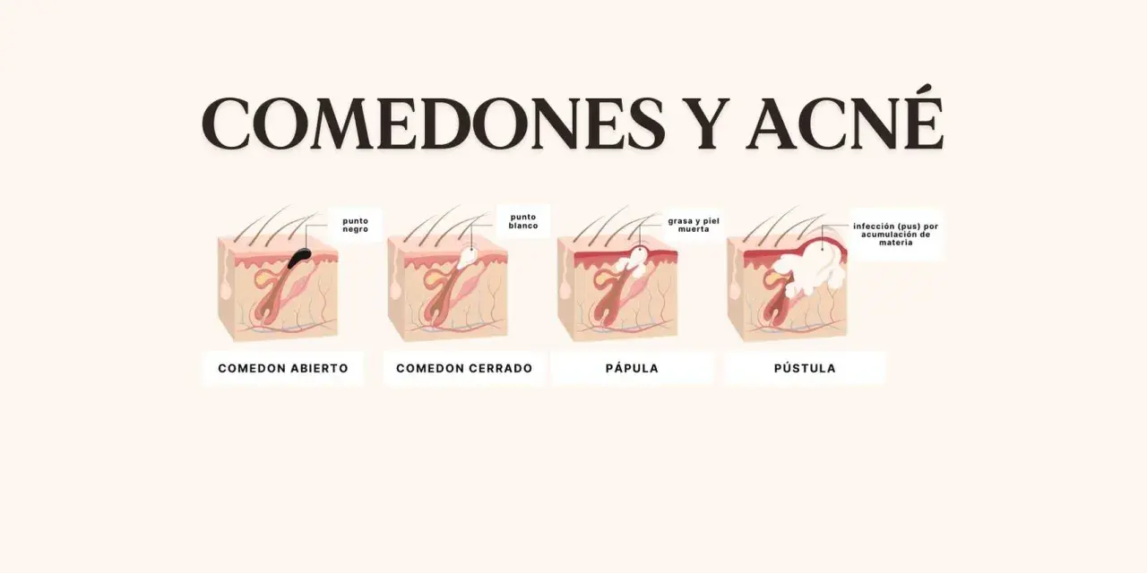 Ilustración explica porque salen puntos negros en la cara: comedón abierto, cerrado, pápula y pústula, mostrando la acumulación de grasa y piel muerta.
