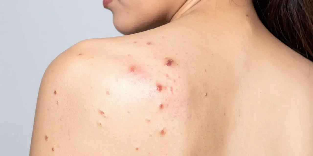 Espalda con acné, mostrando varios granos inflamados sin punta y marcas de curación.