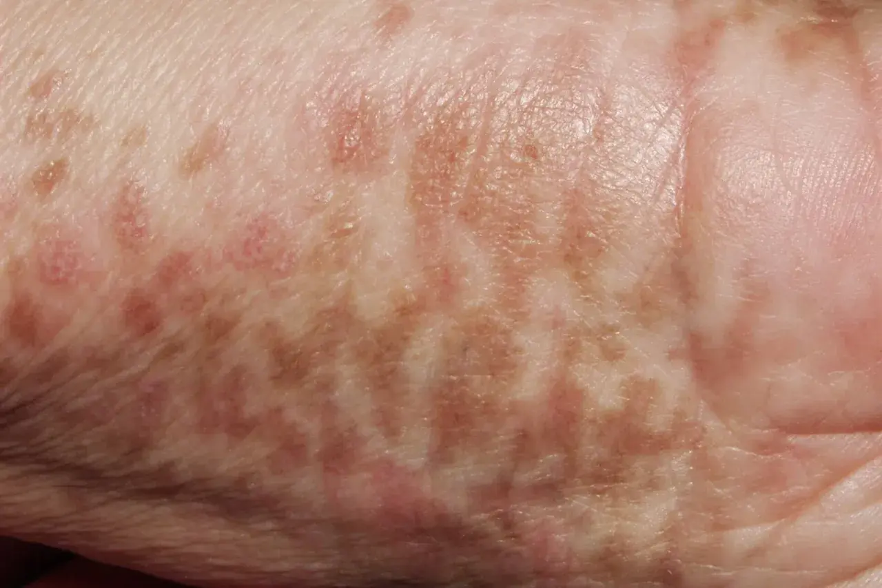 Piel con manchas marrones y rosadas, indicativas de hiperpigmentación postinflamatoria.