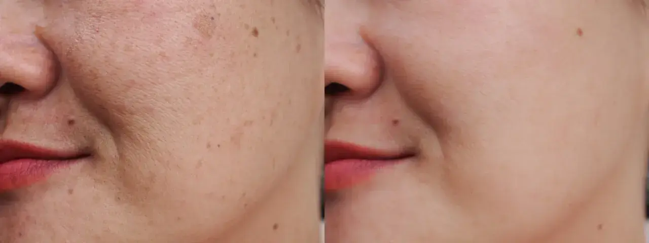 Comparación antes y después de un tratamiento para eliminar manchas de la cara. La piel luce más uniforme y radiante.