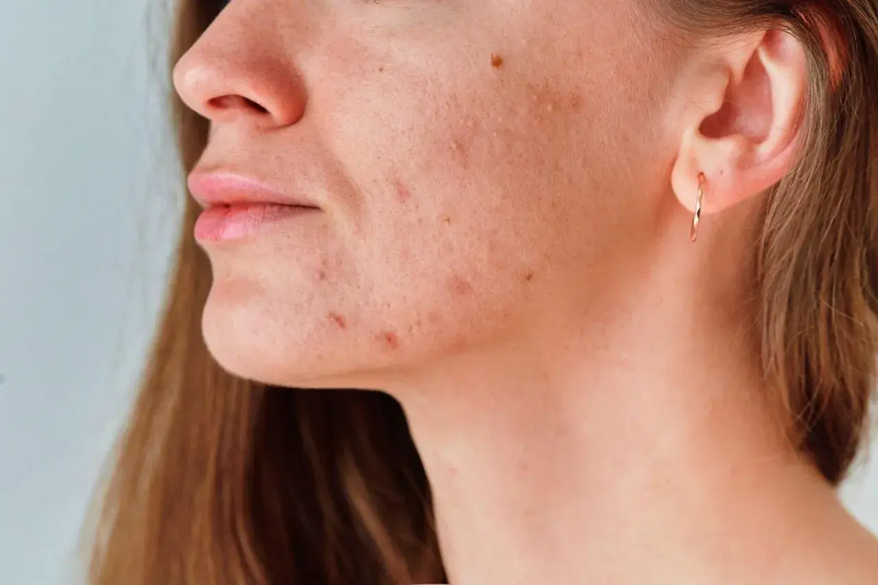 Primer plano de una mujer con granos en el cuello y la mandíbula, mostrando la textura de su piel.