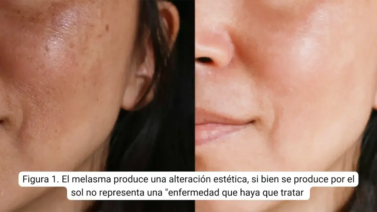 Comparación de piel con melasma y piel tratada. El ácido tranexámico puede ayudar a mejorar la apariencia de las manchas.