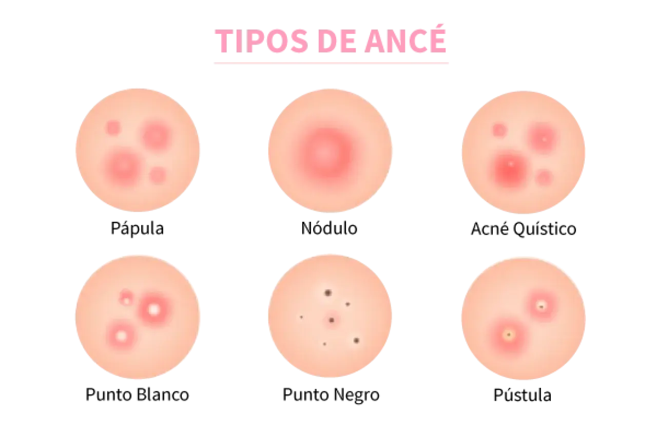 Ilustración de varios tipos de acné: pápula, nódulo, acné quístico, punto blanco, punto negro y pústula.