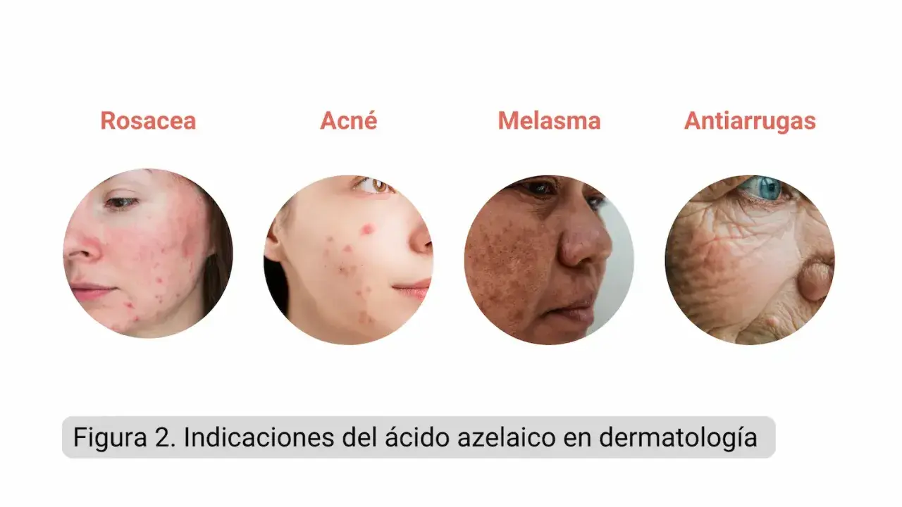 Indicaciones del ácido azelaico: rosácea, acné, melasma y antiarrugas.