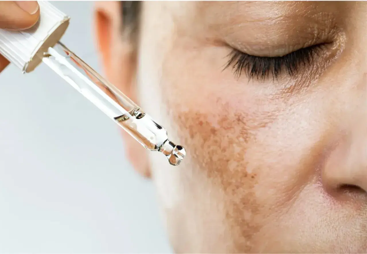 Gotas de suero para tratar el melasma que es, manchas oscuras en la piel.