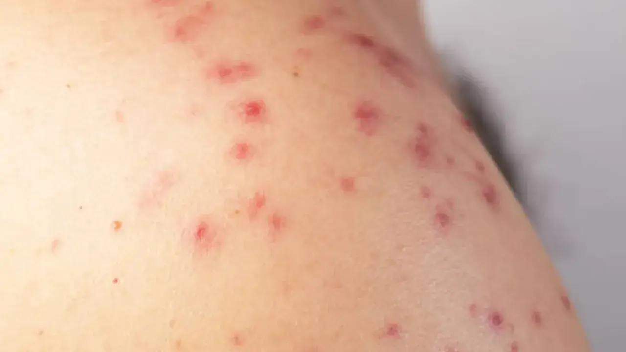 Primer plano de piel con múltiples ronchas rojas, algunas con pequeños puntos blancos, indicando una posible irritación o reacción cutánea.
