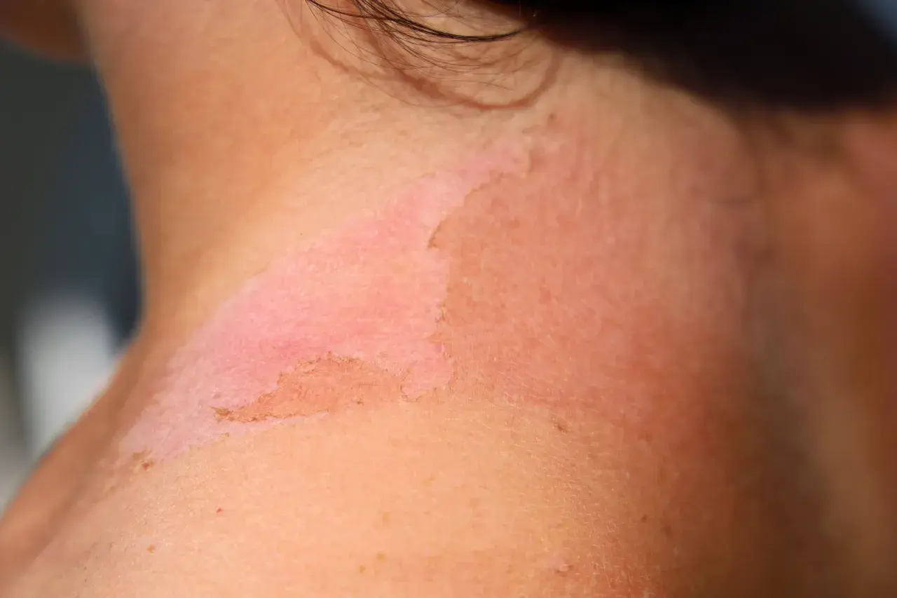 Piel enrojecida y descamada en el cuello, indicativo de un eritema solar severo tras una exposición prolongada al sol.