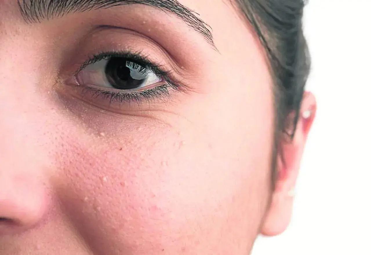Primer plano del ojo y mejilla de una persona con pequeños quistes de milium blancos visibles en la piel.