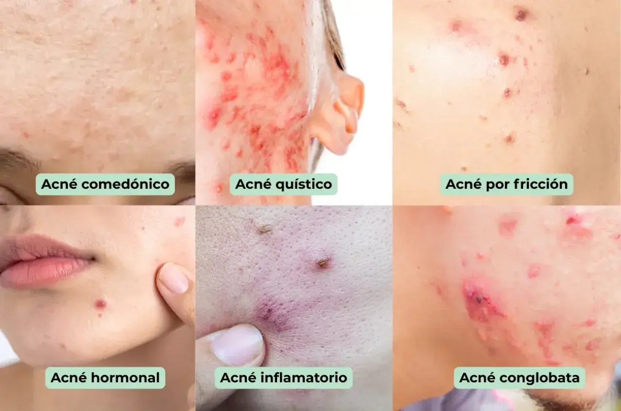 Primer plano de diferentes tipos de acné, incluyendo acné en la frente, quístico, por fricción, hormonal, inflamatorio y   conglobata.