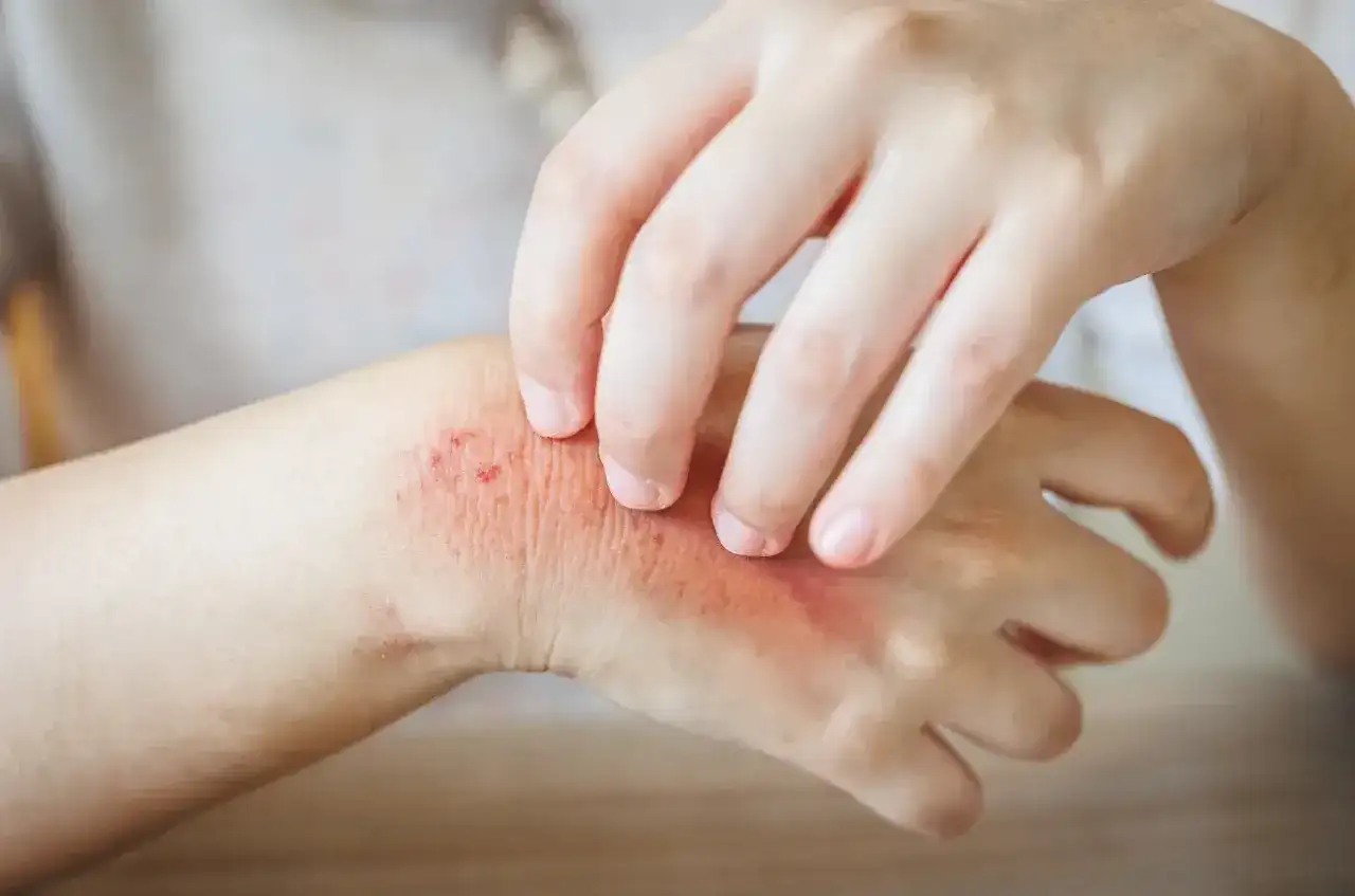 Persona se rasca la mano con erupción roja, posiblemente por hongos en la piel.