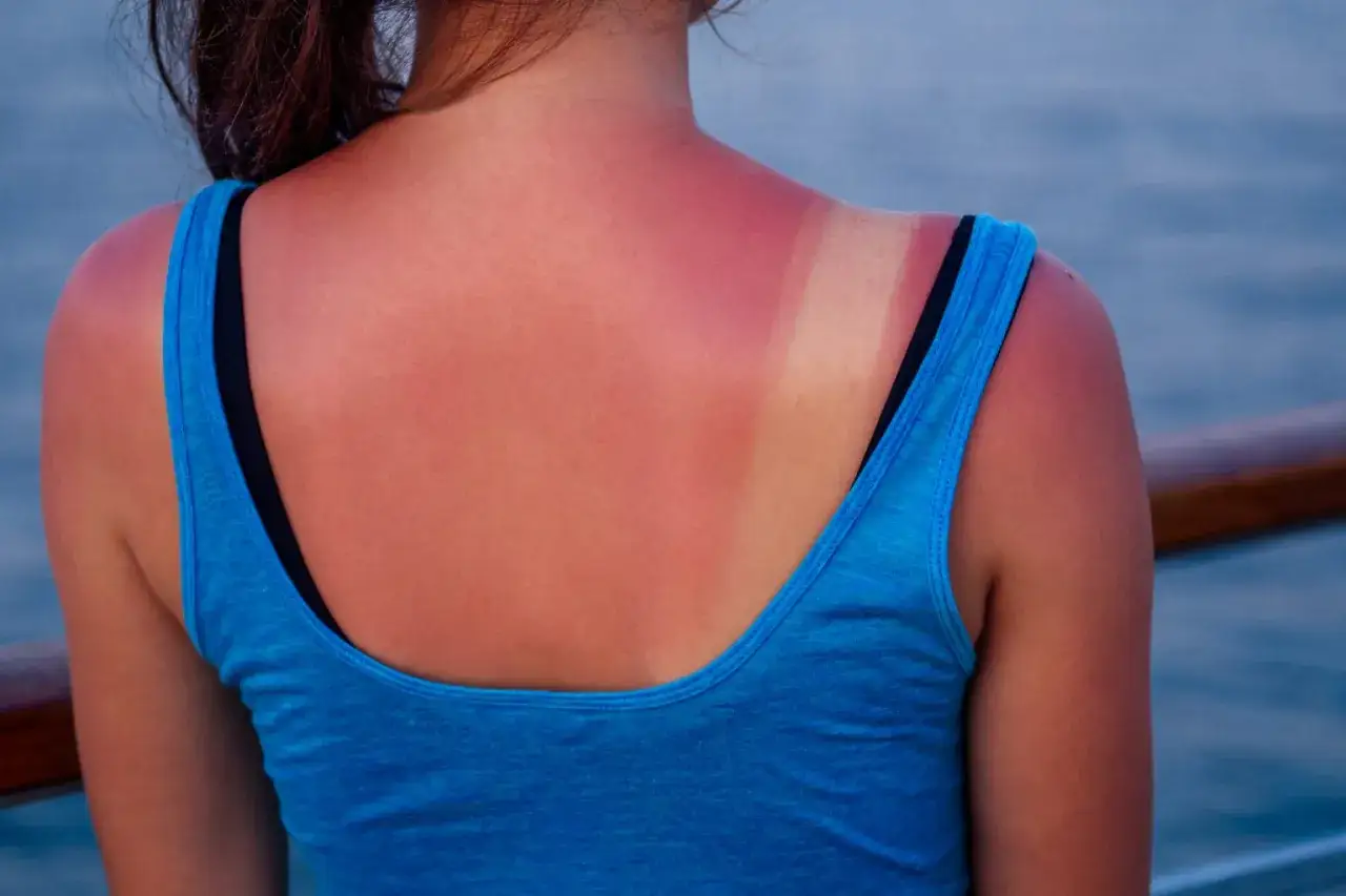 Espalda con eritema solar, enrojecida por el sol, con una marca clara donde el tirante del top azul cubrió la piel.
