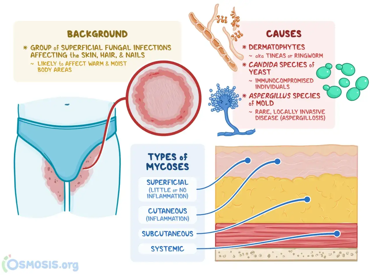 Ilustración sobre hongos en la piel, mostrando causas como dermatofitos y levaduras, y tipos de micosis.