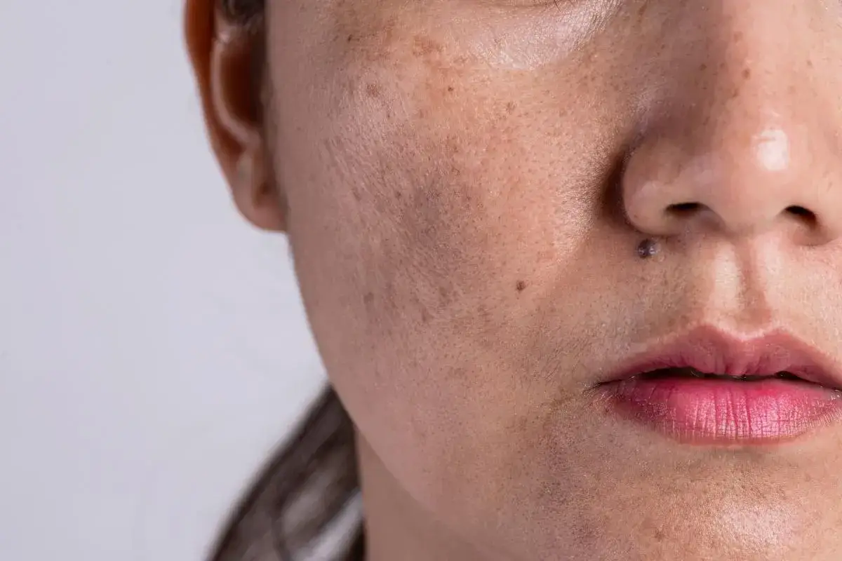 Primer plano de una cara con melasma y un pequeño lunar oscuro sobre el labio superior, simulando un bigote.