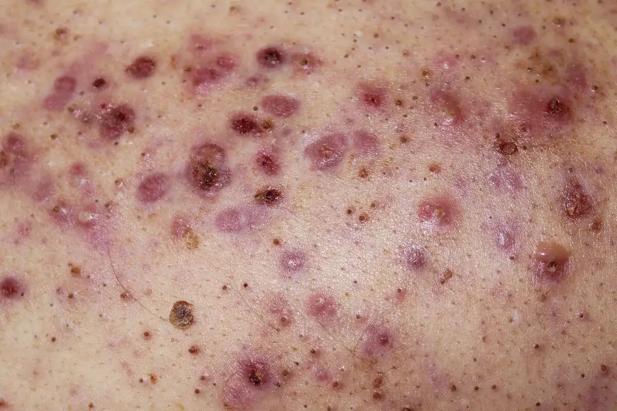 Piel con m&uacute;ltiples p&aacute;pulas, p&uacute;stulas y n&oacute;dulos inflamados, caracter&iacute;sticos del acne conglobata.