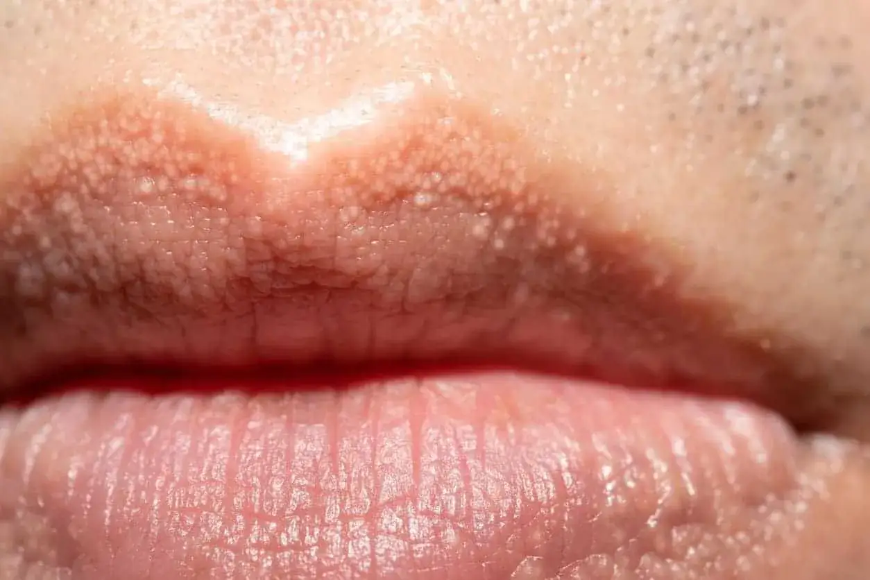 Primer plano de labios con pequeños granitos en la piel, mostrando textura y detalle.