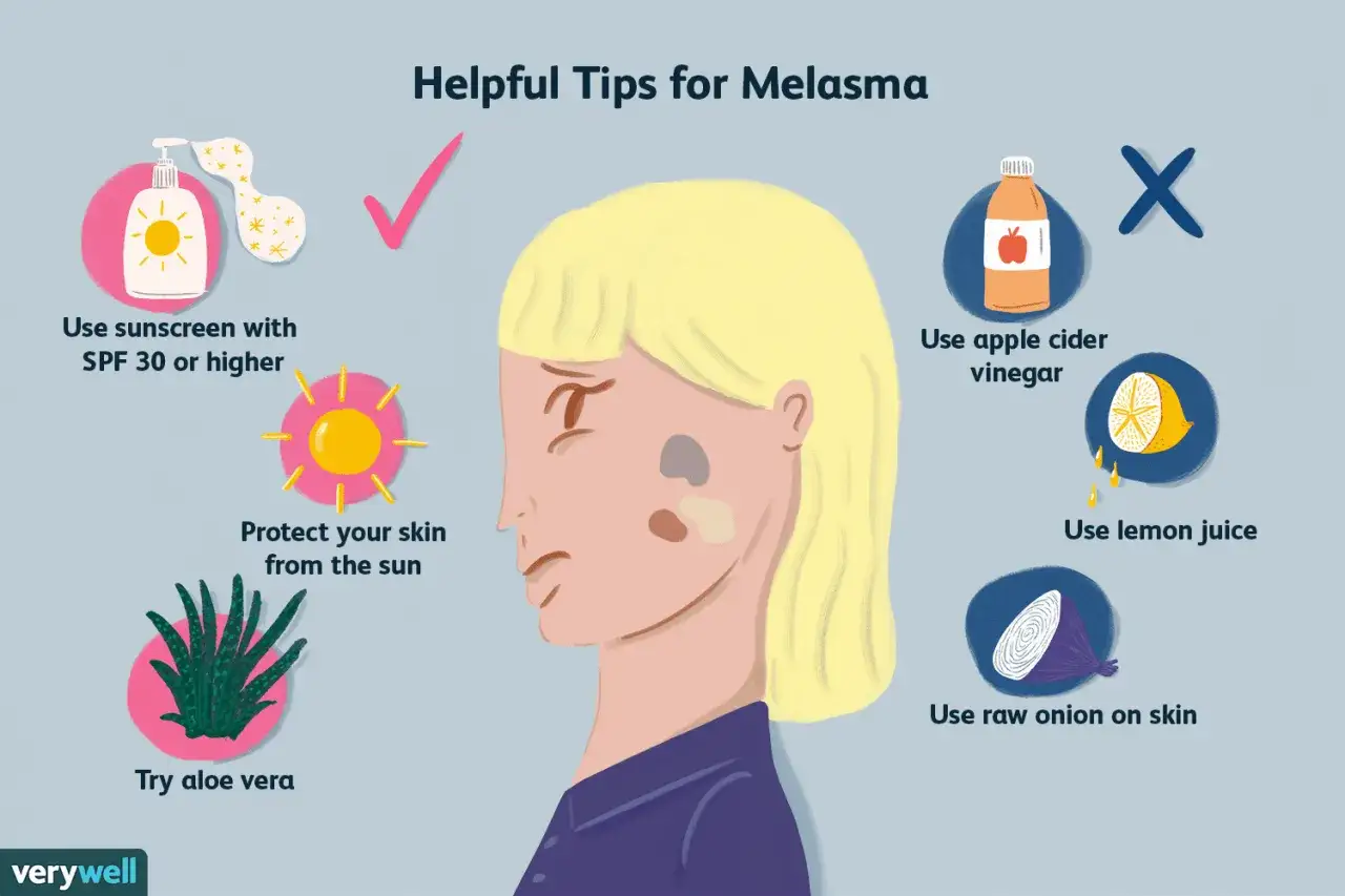 Consejos para el melasma: usa protector solar, aloe vera y protege tu piel del sol. Evita vinagre de manzana, lim&oacute;n y cebolla cruda.