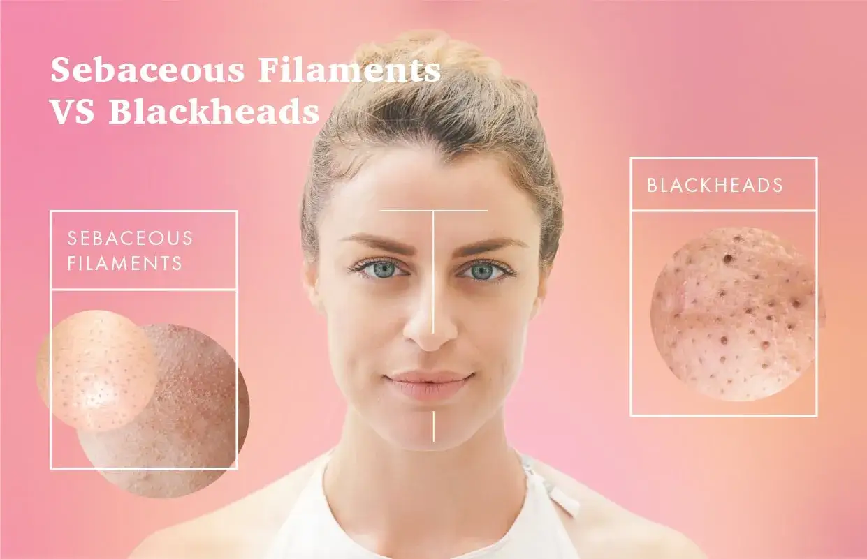 Comparación visual de filamentos sebáceos y puntos negros en la piel.