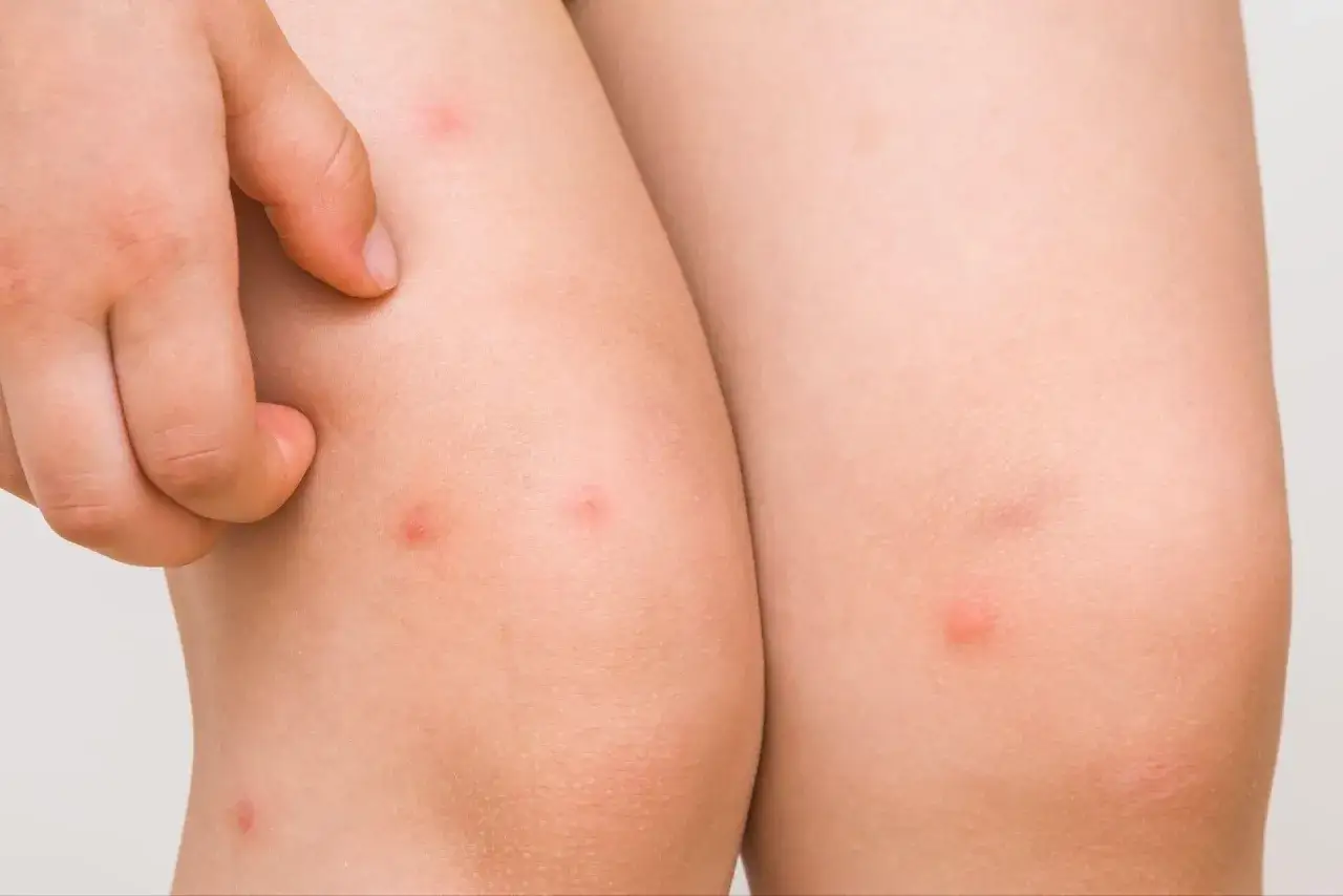 Un niño se rasca las piernas, mostrando pequeños granos por sudor.