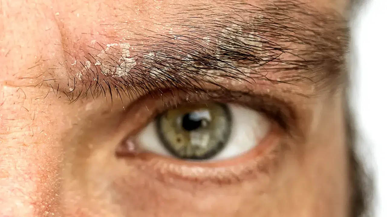 Primer plano de un ojo con caspa en las cejas. La piel alrededor de las cejas está escamosa y seca.
