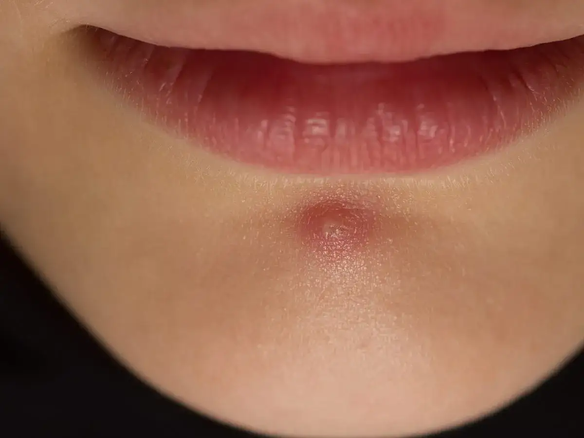 Un grano inflamado sin punta, rojo y abultado, aparece en la barbilla, cerca de los labios.